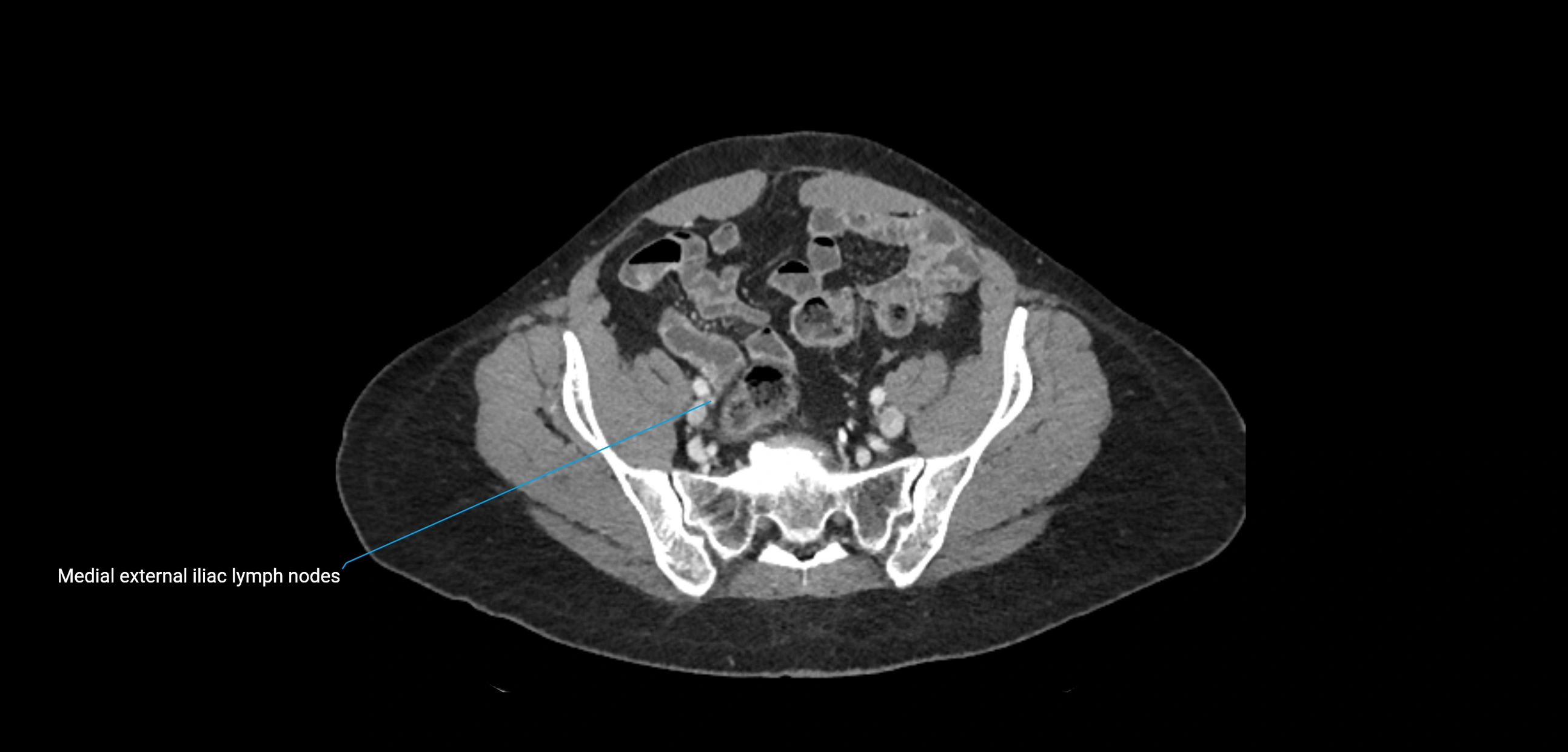CT ct abdominal lymph nodes  axial cross sectional anatomy  enchanced radiology image -img-00002-00330.webp